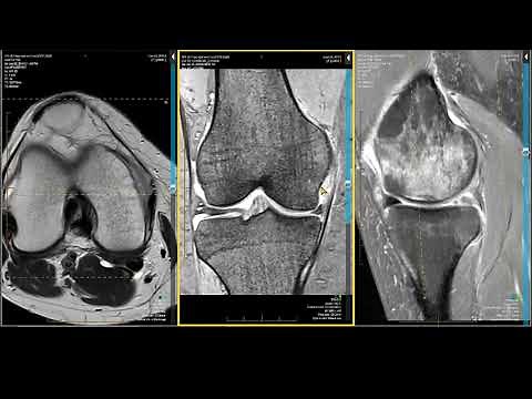 Knee MRI - Meniscocapsular Separation and Subchondral Insufficiency Fracture (SIF)