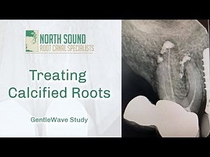 Root Canal Treatment on a Calcified Tooth- GentleWave®