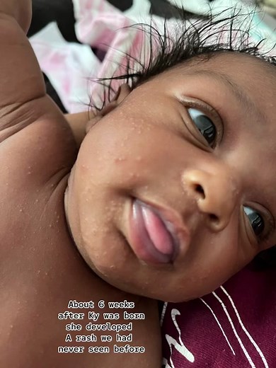 About 6 weeks after Makyah was born she developed a pretty severe rash. She was happy & living her best life (the rash didn’t seem to bother her at all) But we were terrified! And to top it off none of the images on Google were of Black babies so we couldn’t figure out what it was 😒😩 Eventually we were told she had Infant Seborrheic Dermatitis (it’s like severe cradle crap of the face). We were thankfully able to clear it up in about 2 weeks but Chile we were STRESSED OUT! I’d been hesitant ab