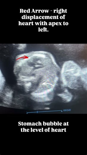 DIAGNOSIS: 🫁 Left Congenital Diaphragmatic Hernia (CDH) detected at 20 weeks gestational age.
