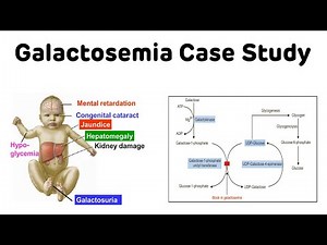 Galactosemia Case Study || Classical Galactosemia || NEXT PG Biochemistry