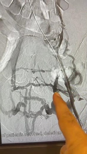 Severe Iliac Vein Blockage Fully Reopened with Stent | Amazing Before & After