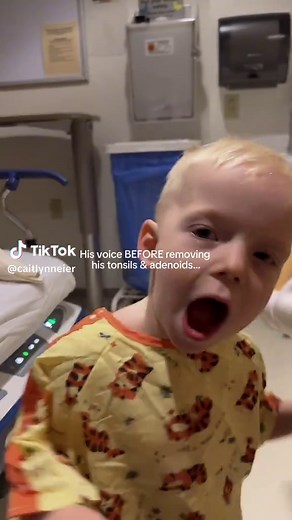 His voice before & after his tonsil and adenoid surgery. The difference is incredible!!! Before surgery, he constantly sounded congested, his breathing and snoring were very loud, and it was clear he was uncomfortable at night. He had grade 4 “kissing” tonsils and grade 4 adenoids that had grown up into his nasal cavity, blocking over 75% of his airway. No wonder he was struggling! 😭 I’m so grateful he finally has relief and gets to experience what it actually feels like to breathe! 🙏🏼 #tonsi