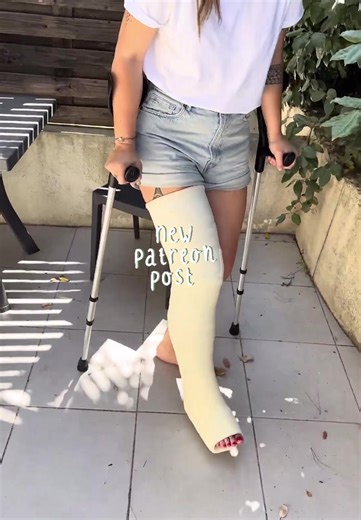 Understanding Medical Casts for Broken Legs and Ankles