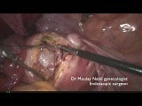 Laparoscopic Myomectomy for Experts Surgeons • Video • MEDtube.net