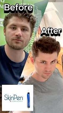 SkinPen microneedling before and after