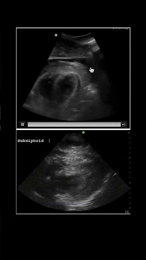 Hemopericardium in the FAST Exam #POCUS #FAST #Trauma #surgery #emergencymedicine #echo #echofirst