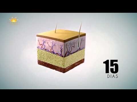 Criolipolisis ¿Como Funciona?