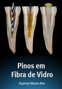 Assista online: Pinos em Fibra de Vidro