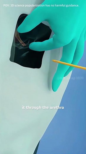 Urinary Catheter Insertion Process (3D Animation)#urinarycatheter #urinarycatheterization
