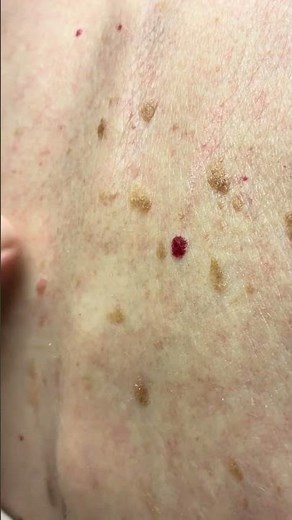 Dr. B shows seborrheic keratosis and hemangioma blood vessels #sk #hemangioma