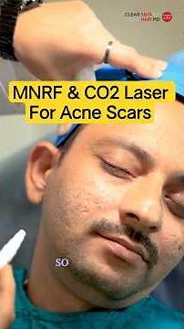 How MNRF And CO2 Laser Remove Acne Scars: Step By Step! | Clear Skin Clinic, Pune