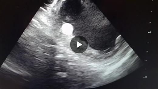 Intracardiac echocardiography visualization of the Sphere-9 catheter confirming tissue contact and precise positioning at the basal posteroseptal region prior to PFA delivery. | JORGE O DIAZ