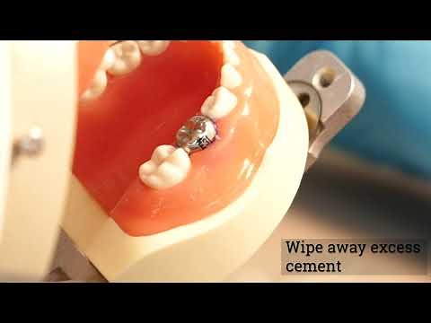 Stainless Steel Crown - Preparation and Placement - Description shows UofU SOD D4 students involved.