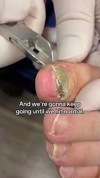 Dermatologist with 50 Years Experience Addresses and Removes Fungus Under Toenail 👨🏻‍⚕️
