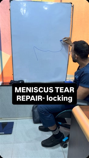 Dr Santhosh Jacob MBBS,DNB,MCh,DABRM on Instagram: "Why Locking & Instability of the Knee Are Indications for Arthroscopy and Meniscal Repair The meniscus is a fibrocartilage shock absorber that distributes load, improves joint stability, and protects the articular cartilage. When it tears—especially after a twisting injury—the torn segment can become unstable. Mechanical symptoms matter. True “locking” (inability to fully extend the knee) usually indicates that a displaced meniscal fragment or 