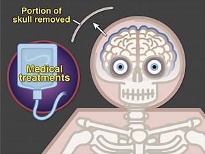 89K views · 1.8K reactions | Intracranial pressure after traumatic...