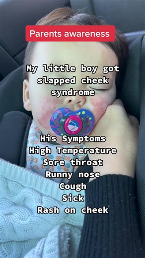 Understanding Slapped Cheek Syndrome in Babies: Symptoms and Treatment