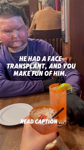 He had a face and double hand transplant. 1. Joe received a face and bilateral hand transplant at 21 years old after a catastrophic accident caused severe burns to most of his body. 2. The transplant was not cosmetic. It was life saving and required one of the most complex surgeries ever performed. 3. Joe lives with lifelong immunosuppression, frequent hospitalizations, and constant monitoring to prevent rejection and infection. 4. Transplant is not a finish line. It is daily work relearning mov