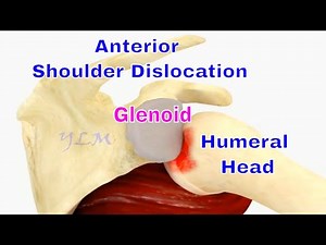 Shoulder Dislocation: How To Tell If You Have A Hill-sachs Lesion