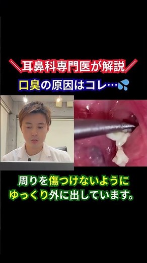 [Tonsillar Stones] The white substance that causes bad breath | Removal by ENT doctors in Minato ...