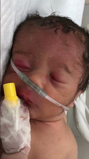 Premature Baby in Critical Condition | Oxygen Support & NICU Care 🍼💔