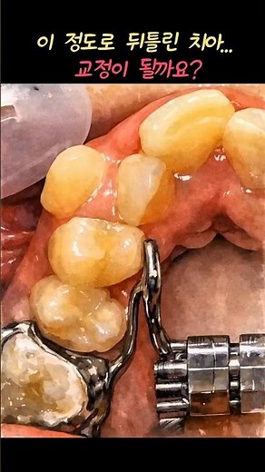 Correction of Severely Crooked Teeth | Orthodontic Correction Without Extraction