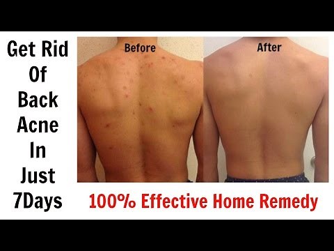 Get Rid Of Back Acne In Just 7 Days || 100% Effective Home Remedy