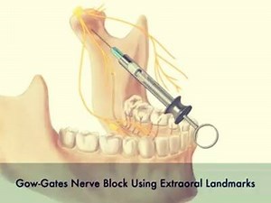 23K views · 703 reactions | Gow-Gates Nerve Block Technique | Dr.Sreenath S | Facebook