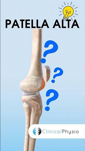 What is Patella Alta? #physiotherapy #physicaltherapy #patella
