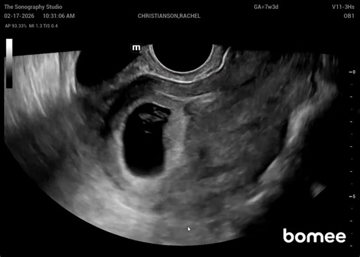 A Glimpse at the Bugaboos: Early Ultrasound of Twins