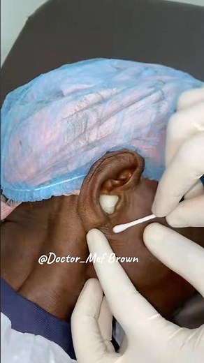 Réaction du peroxyde d’hydrogène sur le cérumen 😳😱 #shorts #viral #doctor