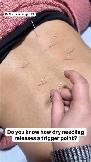 Trigger Point Release with Dry Needling #shorts #backpain #physiotherapy #muscle #musclepainrelief