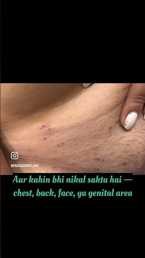 Genital Blisters = STD? NAHI! Sach jaaniye | Dr. Ashima Goel #parisaskinclinic #shingles