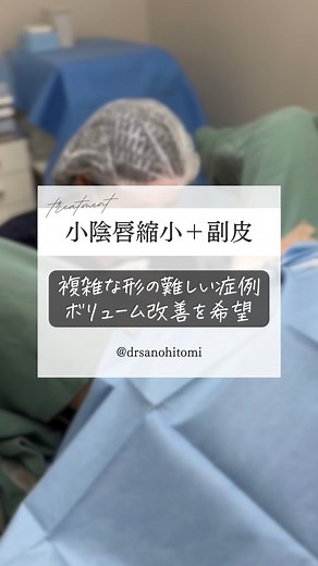 【婦人科形成】佐野仁美｜ルーチェクリニック on Instagram: "@drsanohitomi ◀他の投稿はこちら ⁡ 本日は小陰唇縮小術と副皮切除術、ボンドアウト法での手術でした。 左右に大きく張り出た小陰唇、陰核包皮や副皮のヒダが何重にもなった複雑な形の難しい症例でした。 ⁡ ご本人も陰核包皮と副皮のボリューム改善をご希望でした。 ⁡ 副皮と陰核包皮のヒダがスッキリ整うように、また左右の小陰唇が小さく全体的にバランスの良い形になるように、心を込めてデザインしました。複雑なデザインに沿って、細かく丁寧に組織を切除し、柔らかく内反しやすい皮膚をキレイに縫い合わせ、バランス良く仕上げました。 ⁡ ヒダが解消されると、垢がたまりにくくなりますし、洗いやすく清潔になります。 ⁡ 手術後に笑顔をみせていただけたので、ホッとしました。また来週お待ちしております。 ⁡ ⁡ ⁡ ﹏﹏﹏﹏﹏﹏﹏﹏﹏﹏﹏﹏﹏﹏﹏﹏﹏ ⁡ 無料カウンセリングはこちら ⁡ 📍ルーチェクリニック銀座院 東京都中央区銀座3-3-13 阪急阪神銀座ビル7階 TEL 0120-261-895 ⁡ 🚇アクセス方法 銀座駅