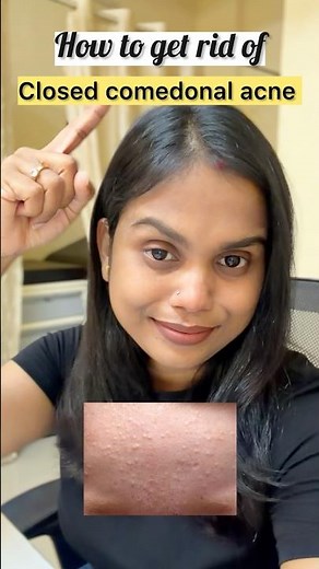 How to get rid of closed comedonal acne #skincare #skincareroutine