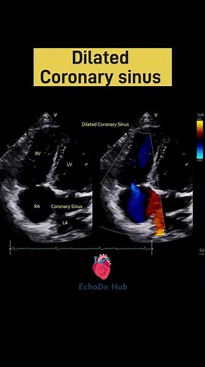 Dilated Coronary Sinus on 2D Echo | EchoDx Hub #2DEcho #PLSVC #CongenitalHeartDisease #Cardiac