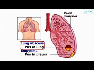 lung abscess
