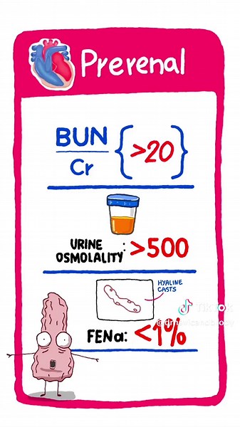 Acute Kidney Injury in 60s💧❌ ✅ Prerenal = poor perfusion → BUN/Cr > 20, FeNa