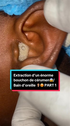 Extraction d’un énorme bouchon de cérumen