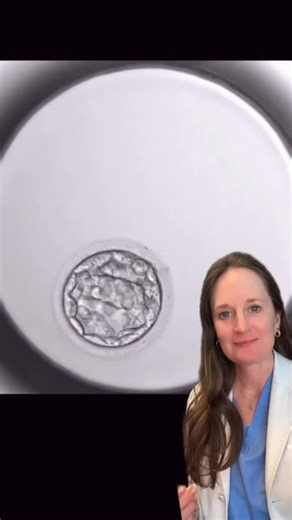 Watching a blastocyst hatch never gets old. ✨ This tiny structure is a blastocyst — an embryo about 5–6 days after fertilization. It’s only about 0.1–0.2 millimeters wide, smaller than the period at the end of this sentence, yet incredibly complex. At this stage, the embryo is made up of: • An inner cell mass, which becomes the baby • An outer layer (trophectoderm), which helps form the placenta Before implantation can happen, the blastocyst must hatch out of its shell (called the zona pellucida