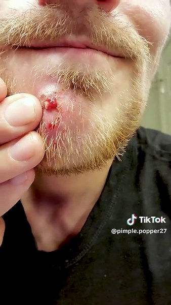 Insane pimple pop #acne #pimple #pimplepopping #blackhead #clean #extractions #satisfying #foryou #fy #fyp