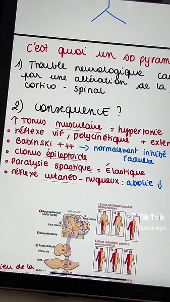Comprendre le syndrome pyramidal en neurologie
