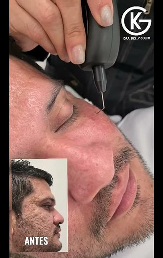 Cicatrices Acné con Plasma IQ Resultado con 1 sesión