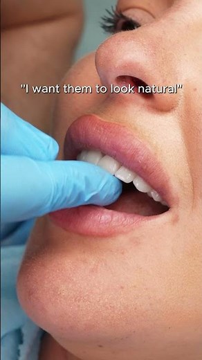 Not all #crowns are too white and bulky