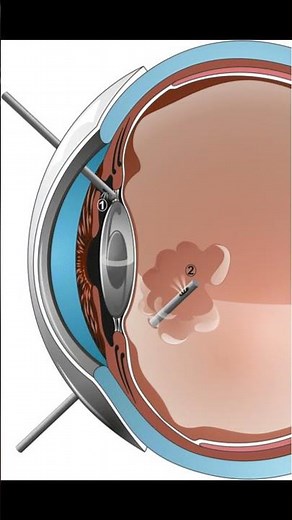 Aqueous misdirection syndrome