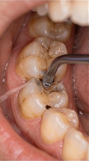 Interproximal cavity between two teeth recovered#satisfying #dentist #shorts #dentalcare #asmr