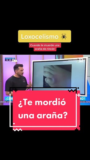 Loxocelismo: ¿Qué hacer si te muerde una araña?