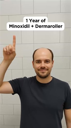 HairCode AI on Instagram: "1 year of minoxidil + Haircode AI 🪮📈 #haircodeai #haircodeapp #minoxidilresult #hairlosstreatment #baldness"