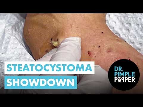 Steatocystoma Showdown — Which One Pops Best?